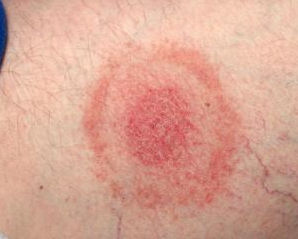 What does a deer tick bite look like?